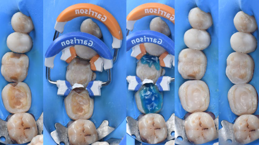 Fig. 3: Restoration of two molars: Filling of the proximal and occlusal cavities.